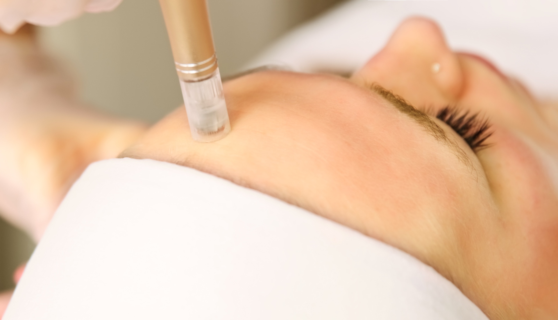 Microneedling med behandlingspenna mot pannan